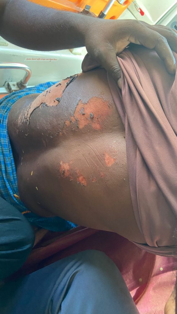 విద్యుత్ షాక్ తగిలి రైతుకు తీవ్ర గాయాలు